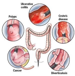 Colonoscopy in Rishikesh