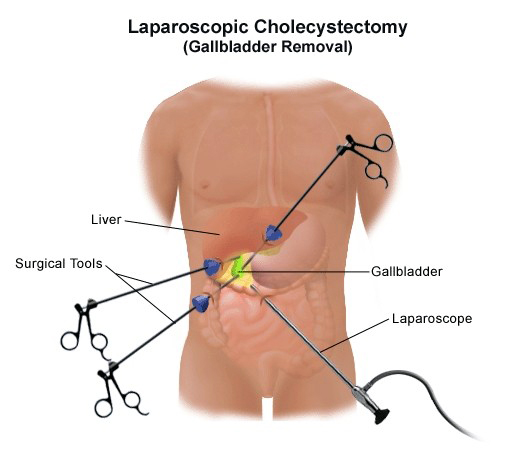 Laparoscopic Gallbladder Surgery in Dehradun for safe and minimally invasive gallstone removal with faster recovery and expert surgical care.