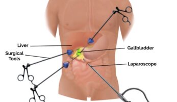 Minimally invasive laparoscopic surgery procedure performed at Panacea Hospital, Rishikesh