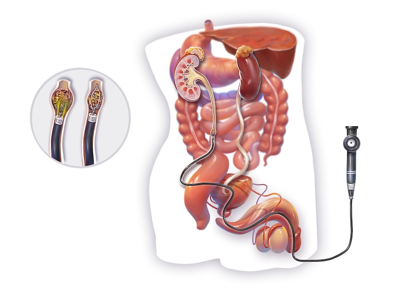 If you are looking for Laser Lithotripsy (URSL) surgery in Rishikesh, Panacea Hospital provides safe, effective, and cashless stone treatment under expert care.