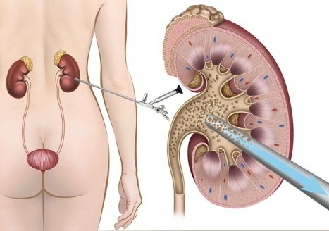PCNL Kidney Stone Surgery in Rishikesh | Panacea Hospital
