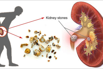 Kidney Stone Treatment in Rishikesh by expert urologist Dr. Vipin Tewani using advanced laser lithotripsy, URS, and PCNL procedures for safe and minimally invasive stone removal.