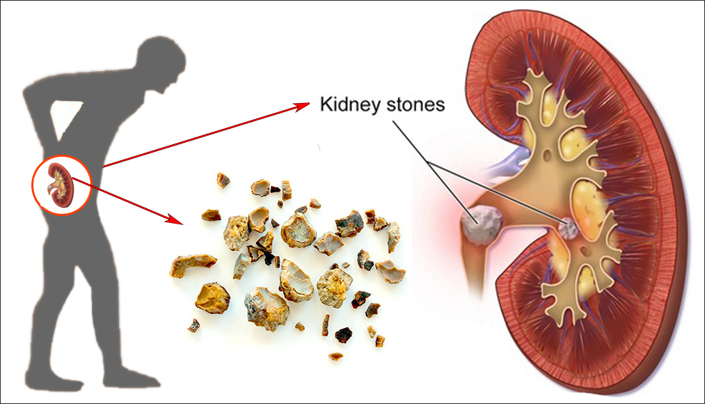 Kidney Stone Treatment in Rishikesh by expert urologist Dr. Vipin Tewani using advanced laser lithotripsy, URS, and PCNL procedures for safe and minimally invasive stone removal.